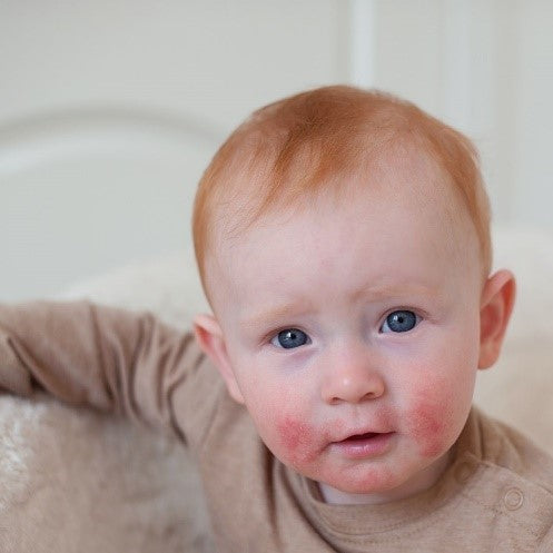 Como cuidar la piel de niños y niñas con dermatitis o eczema en verano.